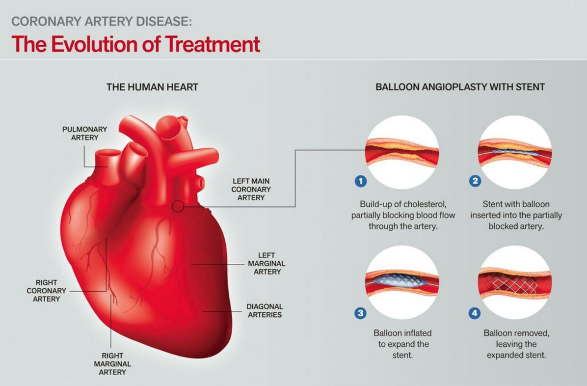 The Evolution Of Treating Heart Conditions St Clair Health